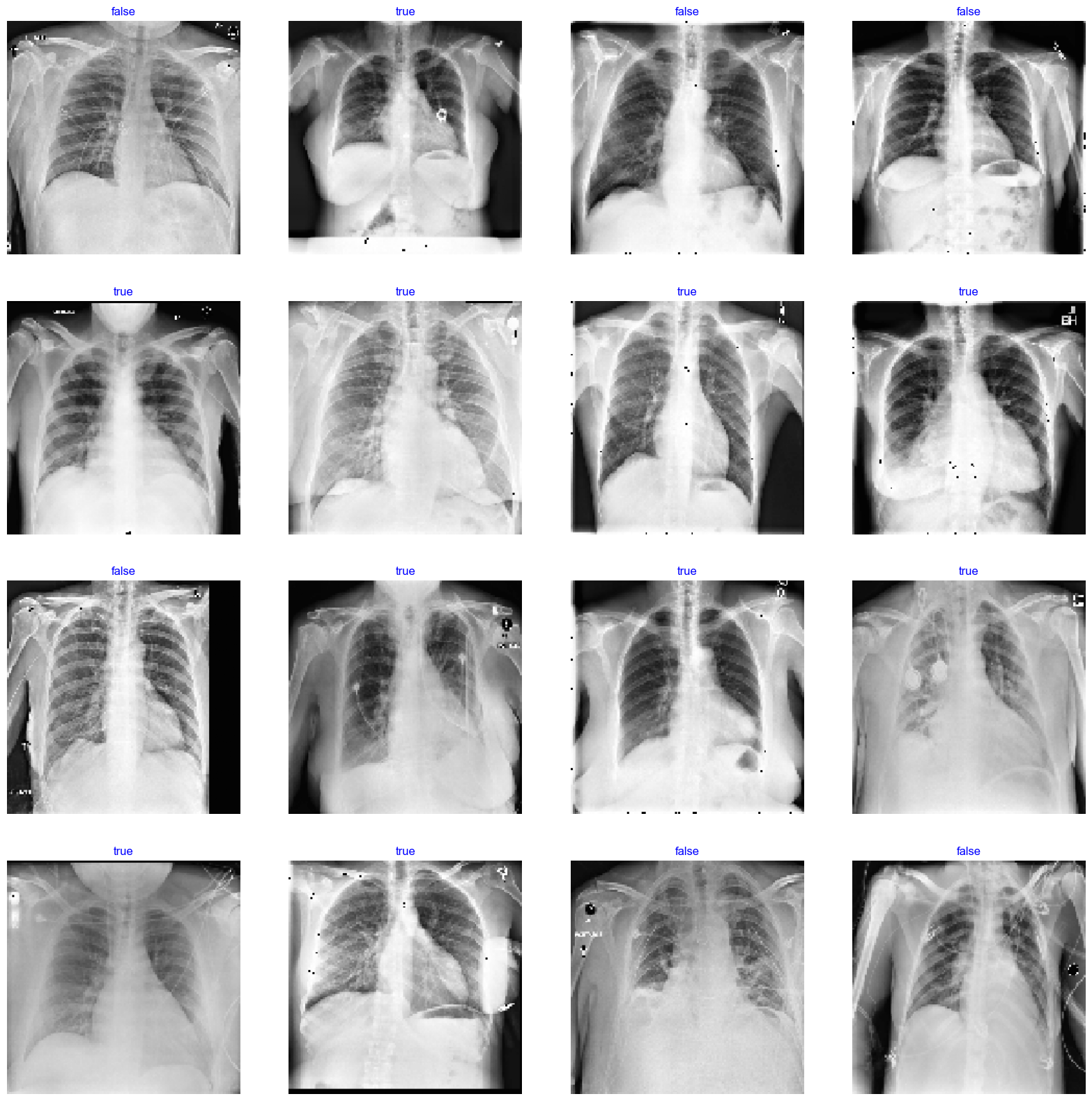 Cardiomegaly Detection (EfficientNet-B7) — Dataset & Transformations