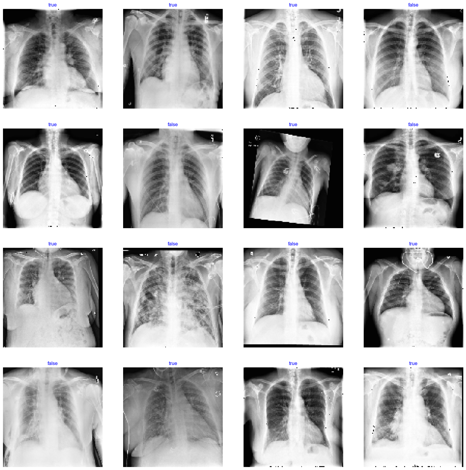 Cardiomegaly Detection (DenseNet-169) — Dataset & Transformations