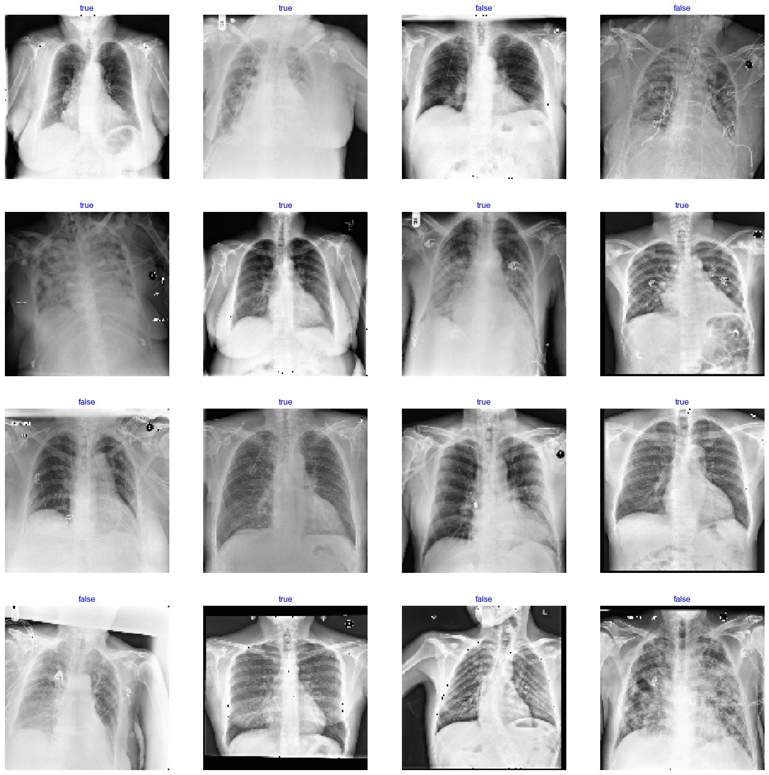 Cardiomegaly Detection (Inception-V3) — Dataset & Transformations