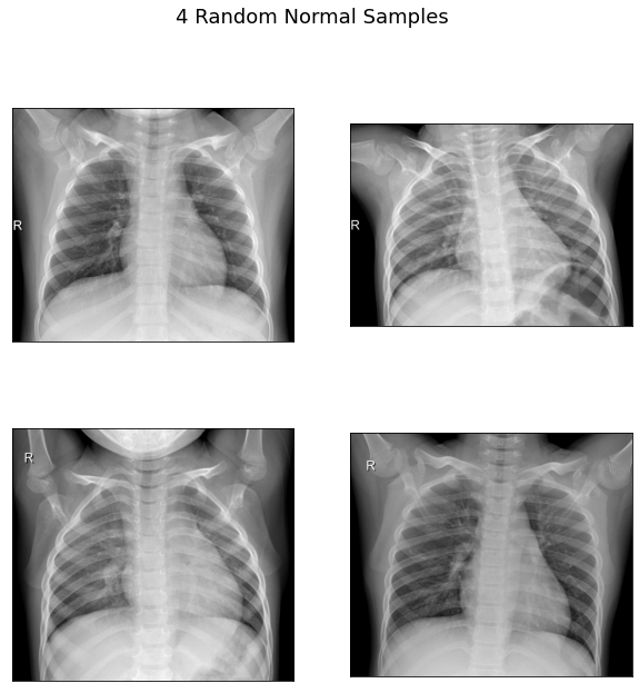 X-Ray Pneumonia Detection